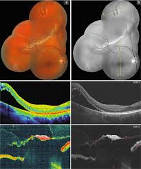 Vitreous fluid flows through a retinal tear to cause a partial retinal detachment involving the macula. Peripheral Retinal Degenerations As A Risk Factor For Rhegmatogenous Retinal Detachment Ento Key