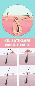 Kil Batiklari Nasil Gecer Batik Cilt Bakimi Saglik