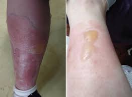 Some in the road would have fought and soon died, were it not close at hand, to let them inside. Waterford Mum Hospitalised After Being Bitten By False Black Widow Spider At Home Irish Mirror Online