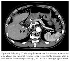 Pancreatic cancer happens when cells in the pancreas begin to grow out of control. Successful Conversion Surgery For Locally Advanced Unresectable Anaplastic Pancreatic Carcinoma After Neoadjuvant S 1 Based Chemoradiotherapy Insight Medical Publishing