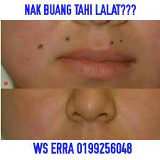 Tahi lalat adalah bintik kecil berwarna cokelat atau kehitaman di atas permukaan kulit. Jom Dapatkan Freeee Laserrr Buang Tahi Lalat Ws Sekarang Jom Atasi Masalah Anda Dengan Kami Ws Erra Sekarang 0199256048 Laser
