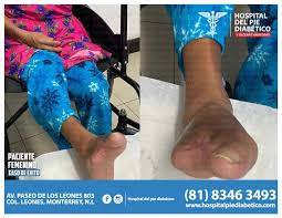 Hospital del Pie Diábetico