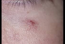 Angiomas are benign tumors that result from an overgrowth. Spider Angioma Picture Image On Medicinenet Com