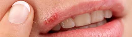 We did not find results for: Cold Sores Causes Symptoms And Treatment Healthdirect