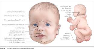 Cara membedakan postpartum depression dengan baby blues syndrome. Noonan Syndrome Gejala Penyebab Pengobatan Dll Hello Sehat