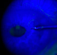 Image result for Eye Foreign Body