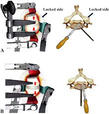 Dec 11, 2017 · this exercise for cervical facet joint pain is quite easy. Immediate Anterior Open Reduction And Plate Fixation In The Management Of Lower Cervical Dislocation With Facet Interlocking Scientific Reports