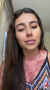 Parte 2 #postcirugia