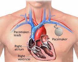 Eu am sa mai insist, nu ma las asa usor, probl. ViaÅ£a Cu Stimulator Cardiac Jurmed Pacienti