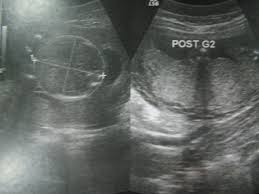 How To Read An Ultrasound Picture Ultrasound Pictures Ultrasound Sonography