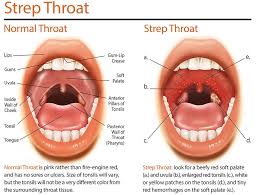 Image result for Strep throat infection roof of mouth