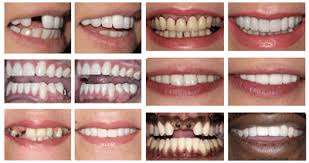 Sadly, no place offers free dental implants or care. A Full Breakdown Of Dental Implant Costs Uk The Perfect Smile