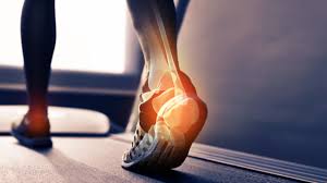 Haufige Fuss Beschwerden Hallux Valgus Knick Senkfuss Morton Neurom Gesundheit Bild De