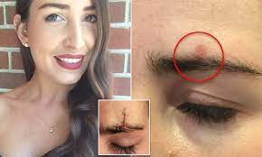 Sometimes, skin cancers can even mimic other common skin problems like rashes and pimples. How A Melbourne Woman S Pimple Turned Out To Be Skin Cancer Daily Mail Online