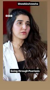 Hareem Farooq Opens Up About Battling Psoriasis During Drama Shoot, Hareem  Farooq has bravely shared her personal struggle with psoriasis, revealing  that she was diagnosed with the condition at the ...