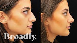 For nose jobs, chin augmentation, liposuction, breast reshaping and more. I Got Surgery To Look Like My Snapchat And Facetune Selfies Youtube