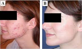 Blue Light Kills Bacteria Safe and Affordable. This should be big news!