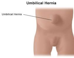 Image result for Inguinal hernia child