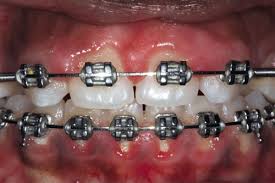 We did not find results for: Restorative Complications Of Orthodontic Treatment British Dental Journal