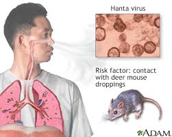Certain kinds of rats and mice in the united states can carry. Hantavirus Information Mount Sinai New York