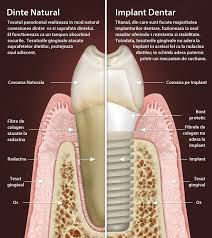 Toti dintii pe care ii va avea vreodata o persoana sunt prezenti inca de la nastere, sus in structura craniului. Pret Implant Dentar Cat Costa Un Implant Implantodent