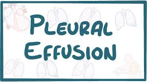 Pleural Effusion Causes Symptoms Diagnosis Treatment Pathology