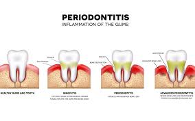 Image result for Gingivitis
