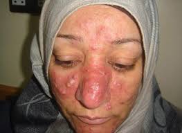 Résultat de recherche d'images pour "rosacea"