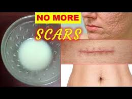 Bio Oil Before And After Old Scars Pin On Remove Marks Scars Remedies