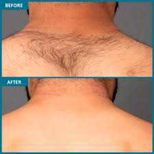 The benefits of laser back hair removal. Laser Hair Removal For Men Milan Laser In Dallas Tx