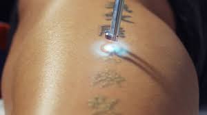 Being a tattoo artist myself, i often get temporary tattoos (which lasts for a few days) on my body before getting a permanent tattoo. How To Remove A Tattoo You Regret Man Of Many