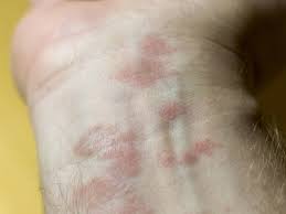 From minor annoyances to deadly diseases, keep an eye out for any changes in your skin that could indicate a common skin disorder. Skin Diseases List Of Common Conditions And Symptoms