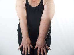 Products For Lymphedema