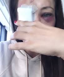 Gamrot trafił palcem w oko irlandczyka, zaś decyzją sędziego marca goddarda walka została uznana za. Karolina Kowalkiewicz Skomentowala Swoj Stan Zdrowia Strasza Mnie Ze Moglabym Nawet Stracic Wzrok