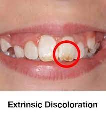 Pin On Complete Guide To Keep Your Teeth White