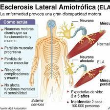Vídeo informativo sobre la esclerosis lateral amiotrófica. Ela En Guatemala Home Facebook