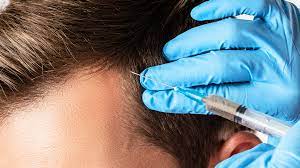 Is PRP for Hair Restoration Safe and Effective? - LT Men's Clinic