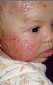 Recognizing food allergy signs in babies