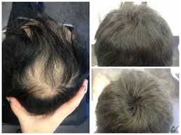 If Your Hair Loss Begins At The Temples Or The Crown Of The Head You May Have Male Pattern Baldness Bald Help Hair Loss Hair Loss Solutions Hair Loss Men