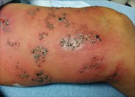 Image result for herpes zoster