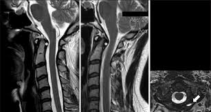 A prevertebral space of less than 6 mm at the level of c3 is considered normal in children (,43). A Magnetic Resonance Imaging Mri Of The Cervical Spine T2 Weighted Download Scientific Diagram
