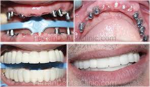 Pin On Ismile Implant And Surgical