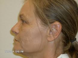 Facelift Photo Gallery