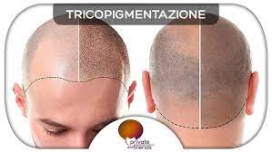 Al fine di simulare la presenza di capelli nelle persone affette da alopecia o per . Tricopigmentazione E Una Soluzione Opinioni Costi E Domande