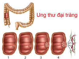 Polip trực tràng và đại tràng. 5 Nhom NgÆ°á»i Dá»… Bá»‹ Ung ThÆ° Ä'áº¡i Trá»±c Trang Antican Vn