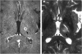 Image result for Thalamotomy