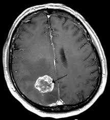 Karenanya, semakin dini penderita tumor otak menyadari bahwa di dalam otaknya tengah berkembang tumor bakal kanker, maka akan semakin baik. Gejala Tumor Otak Penyebab Biaya Berobat Dokter Smarter Health