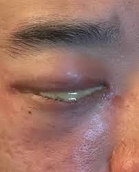 Image result for Gonococcal Conjunctivitis