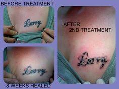 The global community for designers and creative. 8 Non Laser Tattoo Removal Ideas Laser Tattoo Removal Tattoo Removal Laser Tattoo