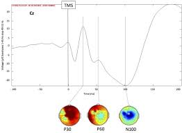 Coffee machine gemelli muscle action diagram. Contribution Of Transcranial Magnetic Stimulation To Assessment Of Brain Connectivity And Networks Abstract Europe Pmc